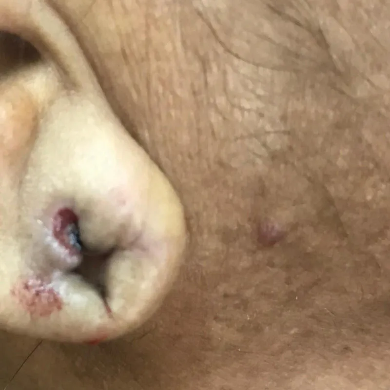 Ear Lobe Before