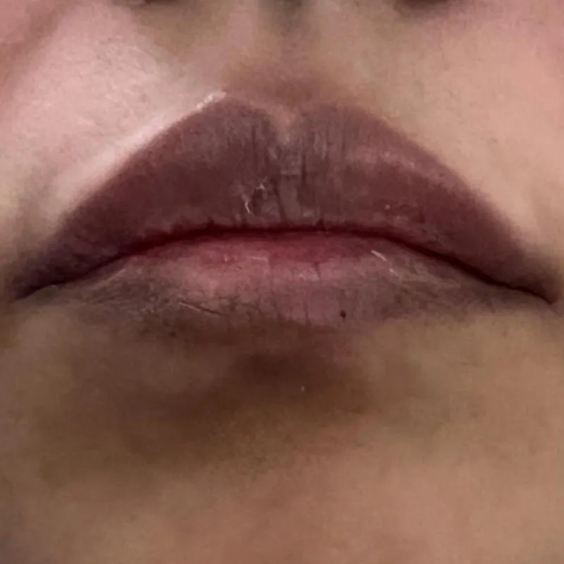 Lip Augmentation After