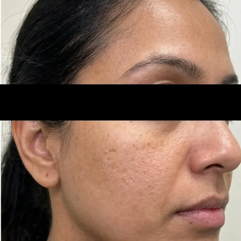 Pigmentation After