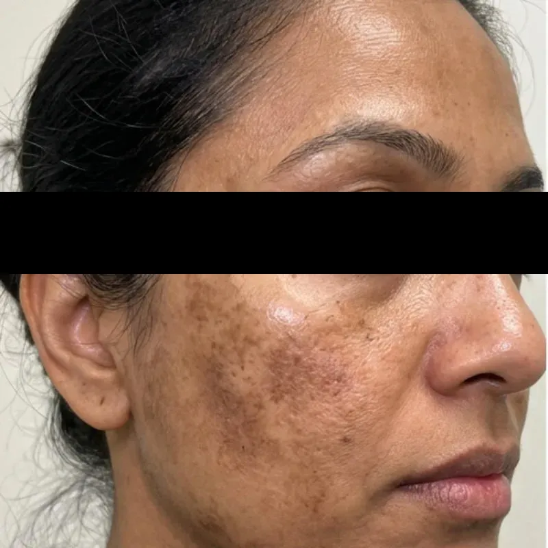 Pigmentation Before
