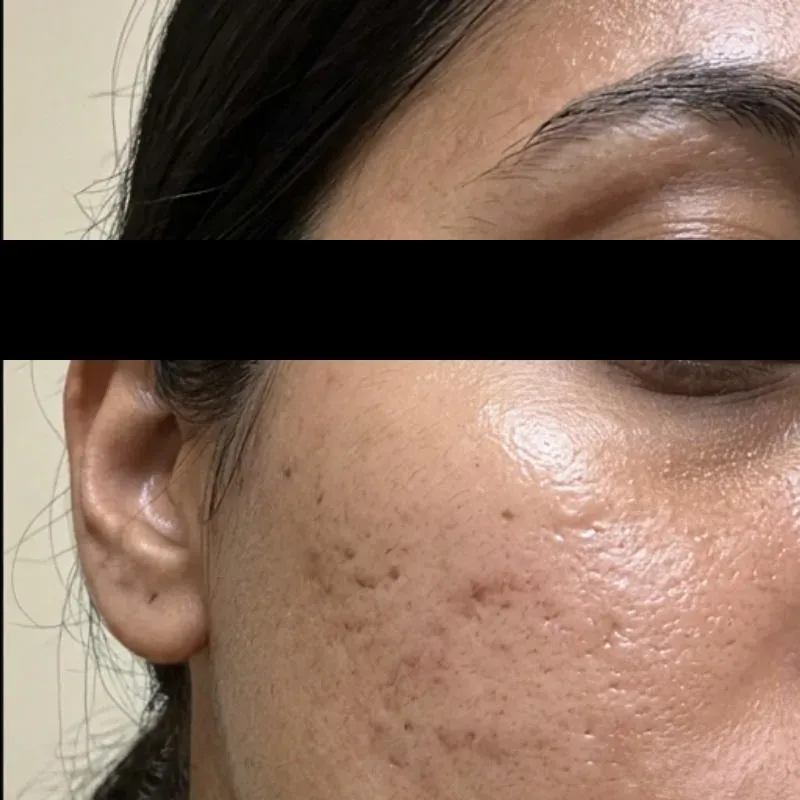 Acne Scar After