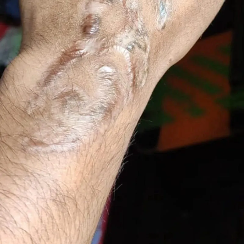 Tattoo Removal After