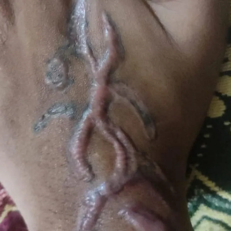 Tattoo Removal Before